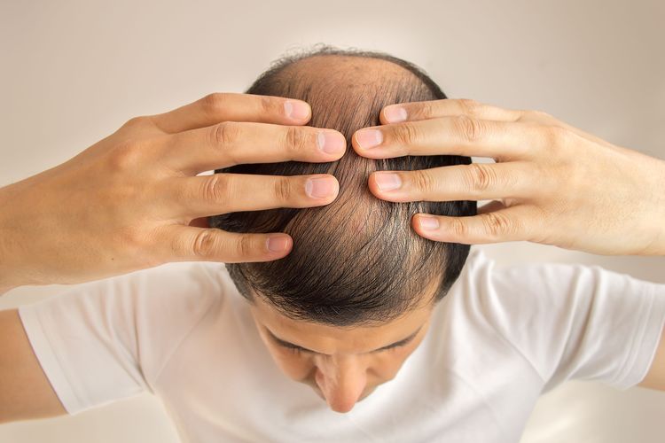 Menumbuhkan Rambut Botak