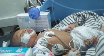 Bayi 2 Tahun Hampir Meninggal Akibat Sembelit, Paru-Paru Terhimpit