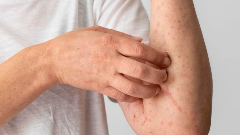 Waspadai Penularan Campak: Kisah Dokter di Cianjur Jadi Pengingat Serius