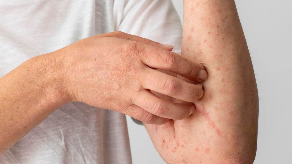 Waspadai Penularan Campak: Kisah Dokter di Cianjur Jadi Pengingat Serius